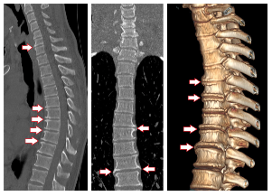 symptoms of degenerative disc disease