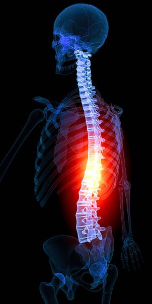 thoracic osteochondrosis