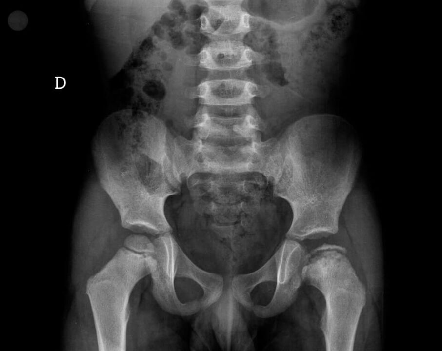 Legg-Calvé-Perthes disease - necrosis of the cartilage tissue of the femoral head