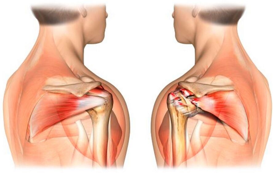 A healthy and arthritic shoulder
