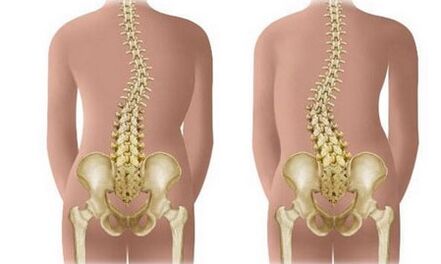 Non -deserted scoliosis