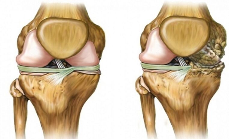 Healthy and affected by arthrosis becomes