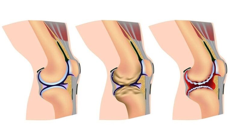 Stages of deformation in the knee joint for arthrosis