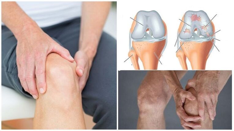 Symptom of knee pain symptom of knee arthrosis joint