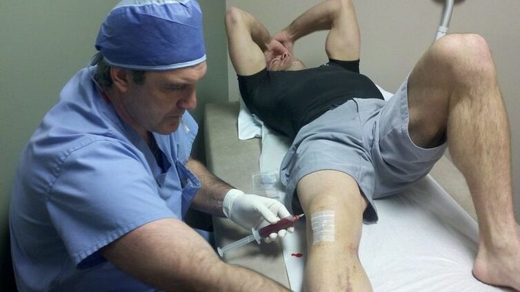 Treatment of knee arthrosis joint