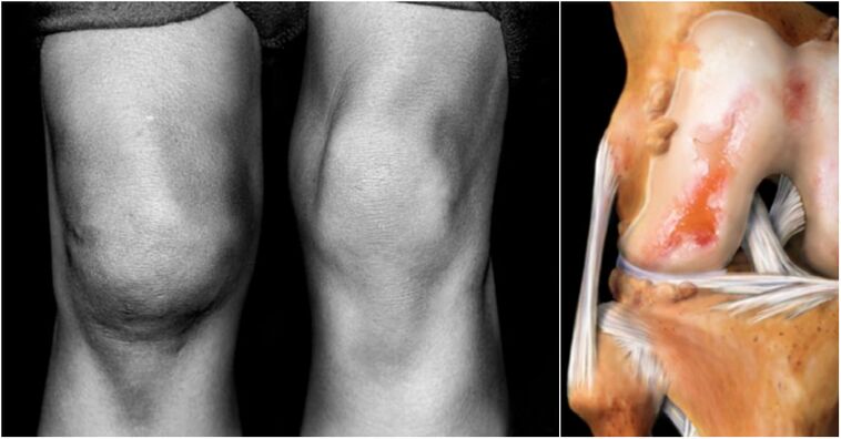 knee arthrosis and inflamed joint
