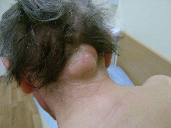 swelling of the neck as a cause of pain