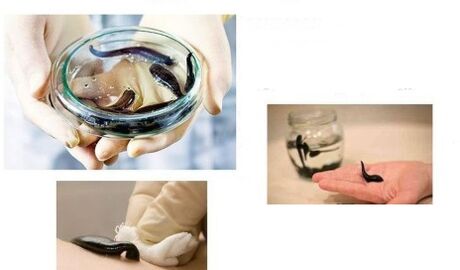 Hirudotherapy for arthrosis
