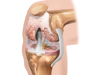 osteoarthritis circuit